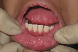 Figure 4: Oral manifestations of condyloma acuminatum (genital warts), confirmed via blood tests and histopathology. Figure 4: Oral manifestations of condyloma acuminatum (genital warts), confirmed via blood tests and histopathology.