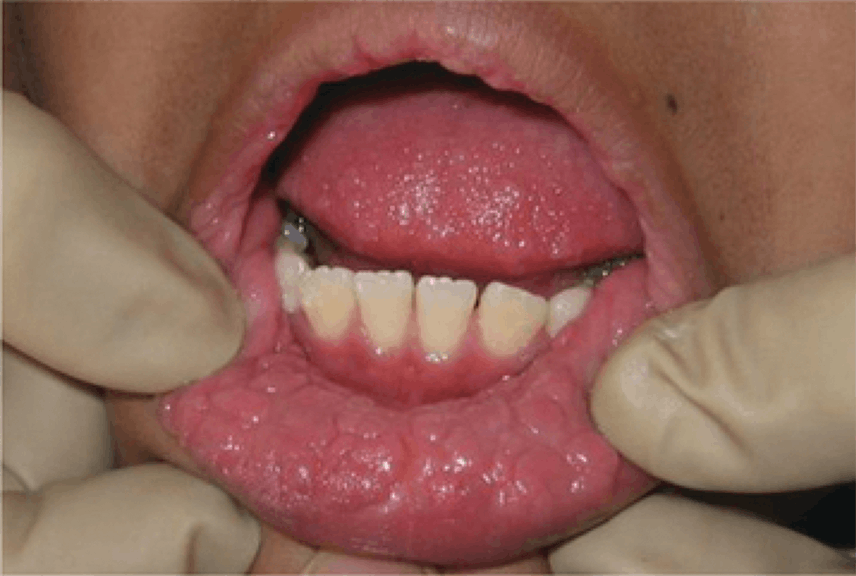 Figure 4: Oral manifestations of condyloma acuminatum (genital warts), confirmed via blood tests and histopathology.