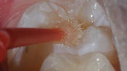 Figure 1d: Adhesive (Futurabond U; Voco GmbH) Figure 1d: Adhesive (Futurabond U; Voco GmbH)