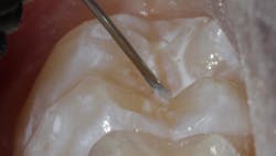 Figure 1e: Grandio Seal placement and light-curing Figure 1e: Grandio Seal placement and light-curing