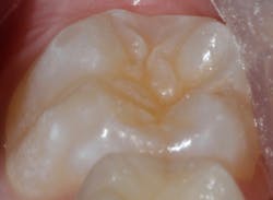 Figure 1a: Preoperative six-year molar and isolation with DryShield (DryShield LLC) Figure 1a: Preoperative six-year molar and isolation with DryShield (DryShield LLC)
