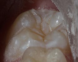Figure 1b: Completed air abrasion Figure 1b: Completed air abrasion