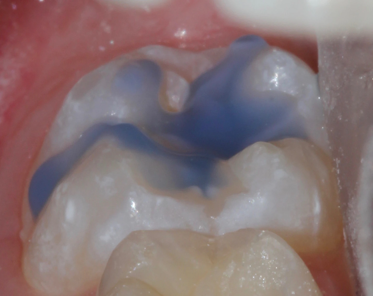 Caries prevention Practical products and proven approaches