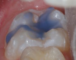 Figure 1c: Etching with 37% phosphoric acid for 10 seconds Figure 1c: Etching with 37% phosphoric acid for 10 seconds
