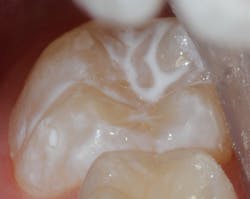 Figure 1f: Final seal Figure 1f: Final seal