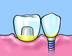 Figure 2: Application of Cervitec Plus to areas susceptible to biofilm formation. Figure 2: Application of Cervitec Plus to areas susceptible to biofilm formation.