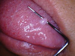 Figure 1: A fibroma on the tongue that the patient reports has been present for several years.