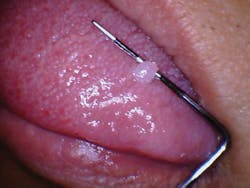 Figure 1: A fibroma on the tongue that the patient reports has been present for several years. Figure 1: A fibroma on the tongue that the patient reports has been present for several years.