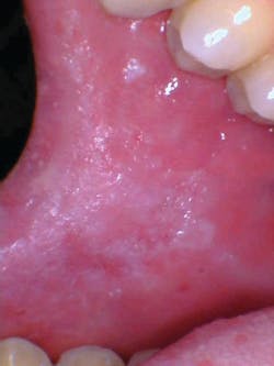 Figure 2: Morsicatio buccarum on the buccal mucosa due to chronic cheek chewing. Figure 2: Morsicatio buccarum on the buccal mucosa due to chronic cheek chewing.