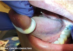 Figure 2: Grasp tongue with moistened, rolled 2x2 gauze to examine and palpate all surfaces. Figure 2: Grasp tongue with moistened, rolled 2x2 gauze to examine and palpate all surfaces.