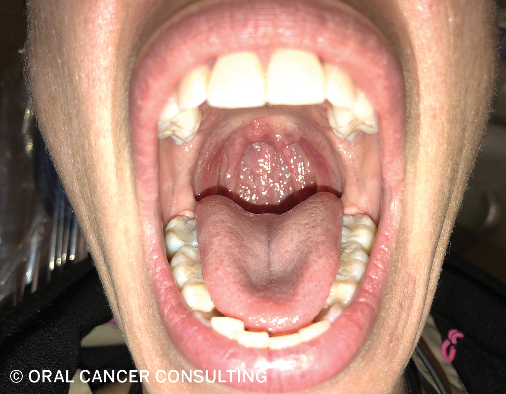 How To Perform A Head And Neck Oral/ Oropharyngeal Cancer Screening ...