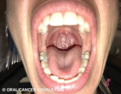 Figure 3: Examine all areas of the oropharynx. Figure 3: Examine all areas of the oropharynx.