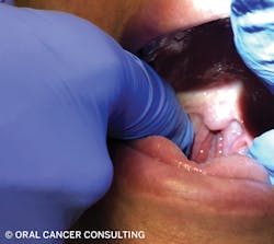 Figure 4: Palpate glossotonsillar sulcus. Figure 4: Palpate glossotonsillar sulcus.