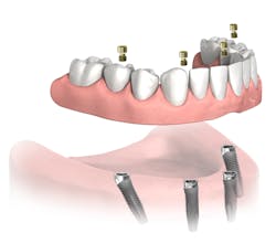 Figure 3: Full denture on four implants. Used with permission of John Hodges, DDS.