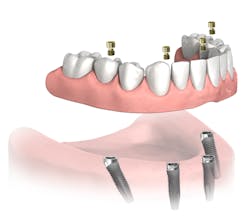 Figure 3: Full denture on four implants. Used with permission of John Hodges, DDS. Figure 3: Full denture on four implants. Used with permission of John Hodges, DDS.
