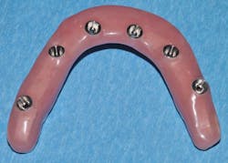 Figure 5: Convex intaglio design. Used with permission of John Hodges, DDS. Figure 5: Convex intaglio design. Used with permission of John Hodges, DDS.
