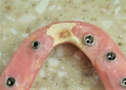 Figure 6: Calculus on provisional. Used with permission of John Hodges, DDS. Figure 6: Calculus on provisional. Used with permission of John Hodges, DDS.