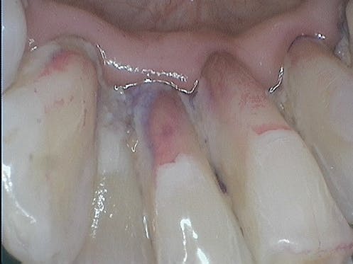 Figure 2: Image of lower anterior teeth prior to any treatment