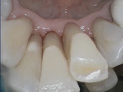 Figure 3: Image of lower anterior teeth following use of Air-Flow Plus powder with erythritol, prior to any hand or power instrumentation Figure 3: Image of lower anterior teeth following use of Air-Flow Plus powder with erythritol, prior to any hand or power instrumentation