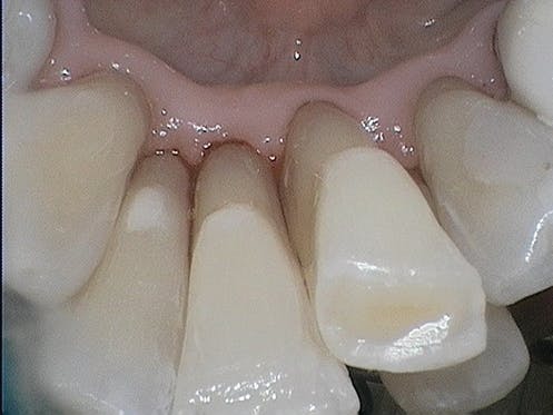 Figure 3: Image of lower anterior teeth following use of Air-Flow Plus powder with erythritol, prior to any hand or power instrumentation