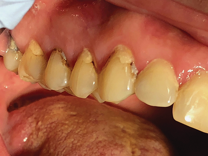 Silver diamine fluoride (SDF) Dental caries in older adult patients