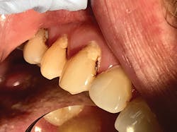 Figure 2: Same patient one week later Figure 2: Same patient one week later