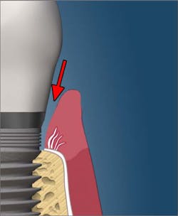Access for opportunistic bacteria to enter pocket and bone Access for opportunistic bacteria to enter pocket and bone