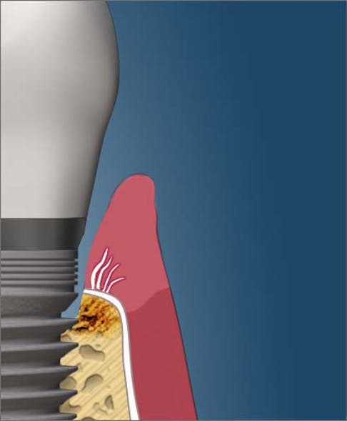 Bacterial toxins destroying bone