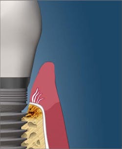 Bacterial toxins destroying bone Bacterial toxins destroying bone