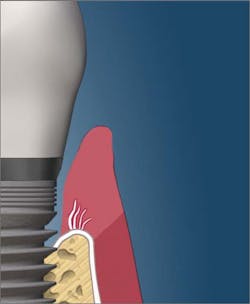 Horizontal bone loss appearing on radiographs Horizontal bone loss appearing on radiographs