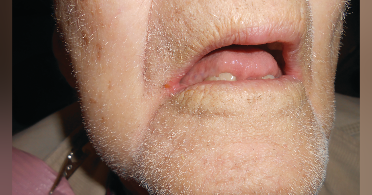 Angular Cheilitis Definition Clinical Features And Treatment
