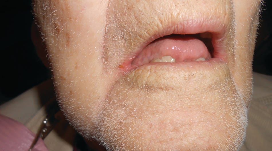 Angular cheilitis treatment over the counter deals