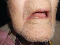 Figure 1: An 80-year-old man with chronic angular cheilitis. Note the loss of dimension due to tooth loss and dermal dexterity.