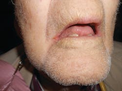 Figure 1: An 80-year-old man with chronic angular cheilitis. Note the loss of dimension due to tooth loss and dermal dexterity. Figure 1: An 80-year-old man with chronic angular cheilitis. Note the loss of dimension due to tooth loss and dermal dexterity.