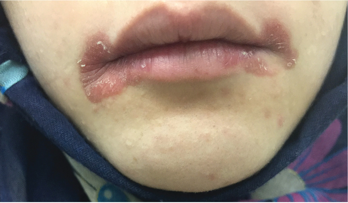 The Multiple Etiologies Of Angular Cheilitis | Registered Dental Hygienists