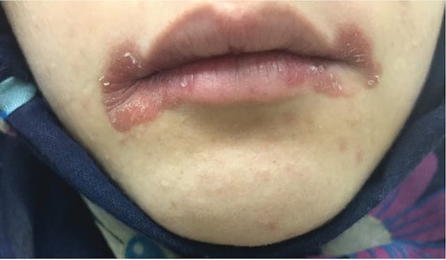 Angular cheilitis treatment top over the counter