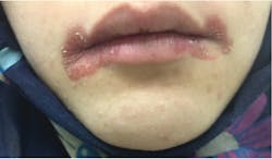 Figure 2: This patient had chronic angular cheilitis that continued to progress. It was determined that the patient had iron-deficiency anemia.