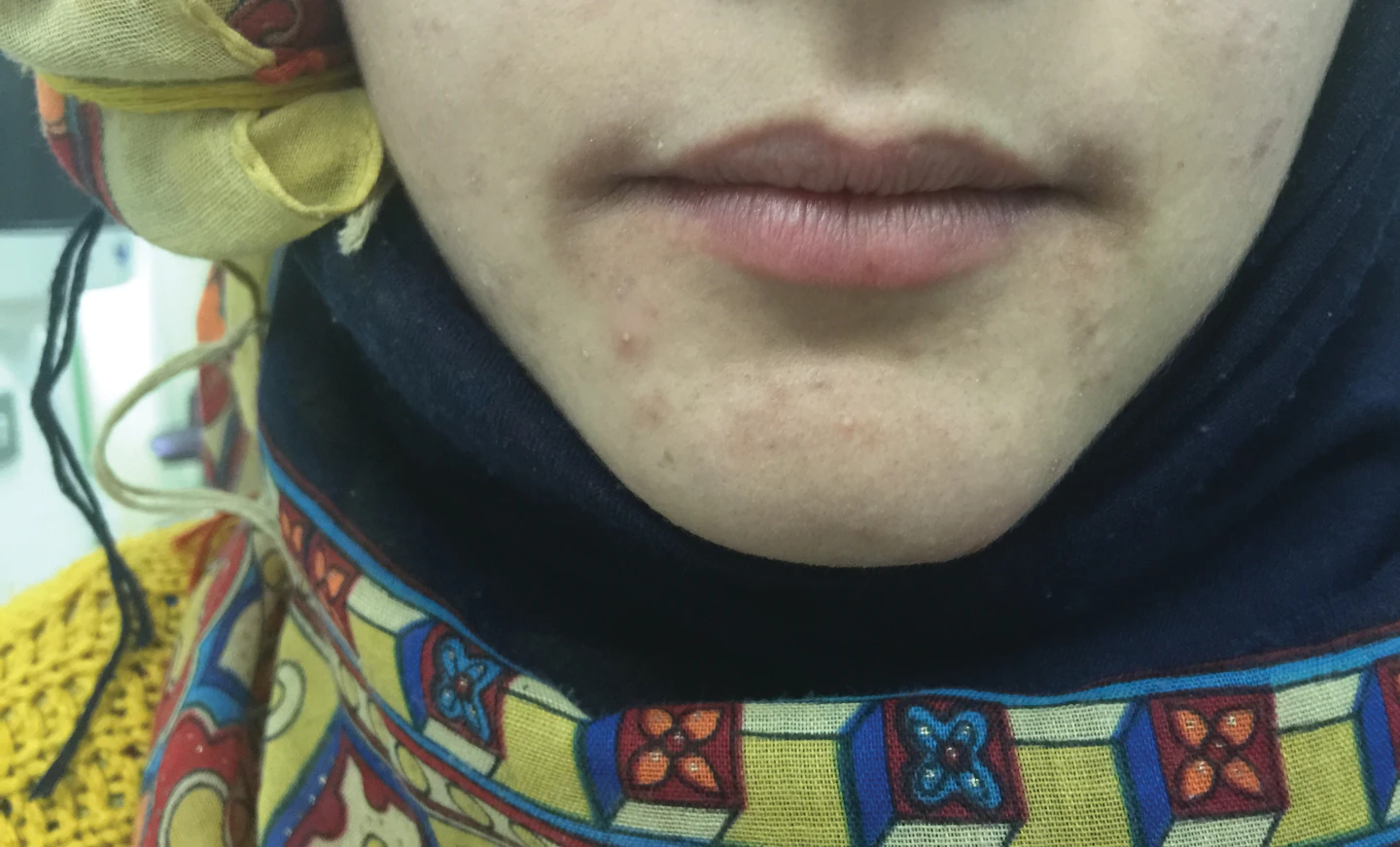 The multiple etiologies of angular cheilitis | Registered Dental ...