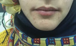 Figure 3: Same patient from figure 2 with iron-deficiency anemia evaluated two years after treatment. The patient was left with some noticeable scarring/discoloration of tissue. Figure 3: Same patient from figure 2 with iron-deficiency anemia evaluated two years after treatment. The patient was left with some noticeable scarring/discoloration of tissue.