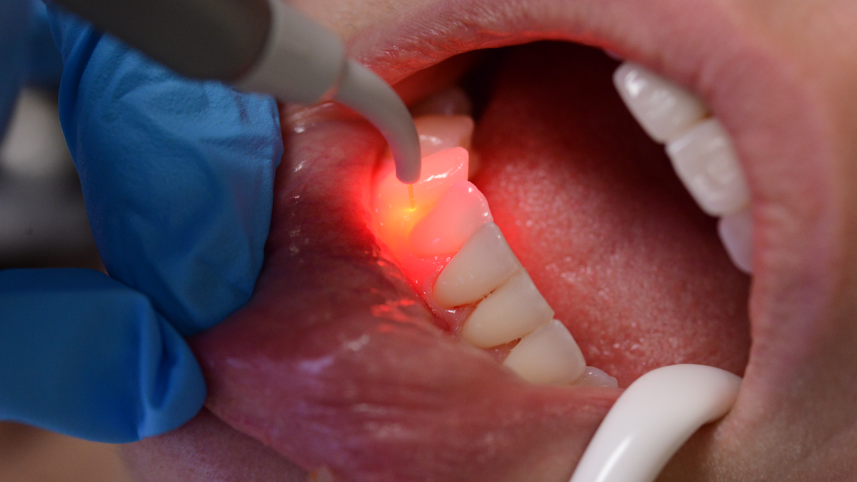 Image result for Is Laser treatment in dentistry safe for teeth?