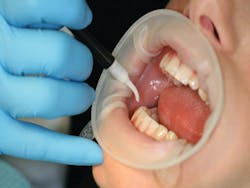 Demonstrating the delicate nature of the laser fiber optic placement Demonstrating the delicate nature of the laser fiber optic placement