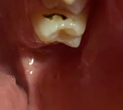 Figure 1: SDF used directly on mesial tooth surface to arrest early-stage caries