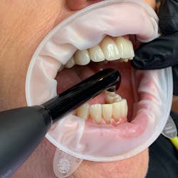 Figure 1: Nonreflective environment: OptraGate (Ivoclar Vivadent), black gloves, and black probe light. Figure 1: Nonreflective environment: OptraGate (Ivoclar Vivadent), black gloves, and black probe light.