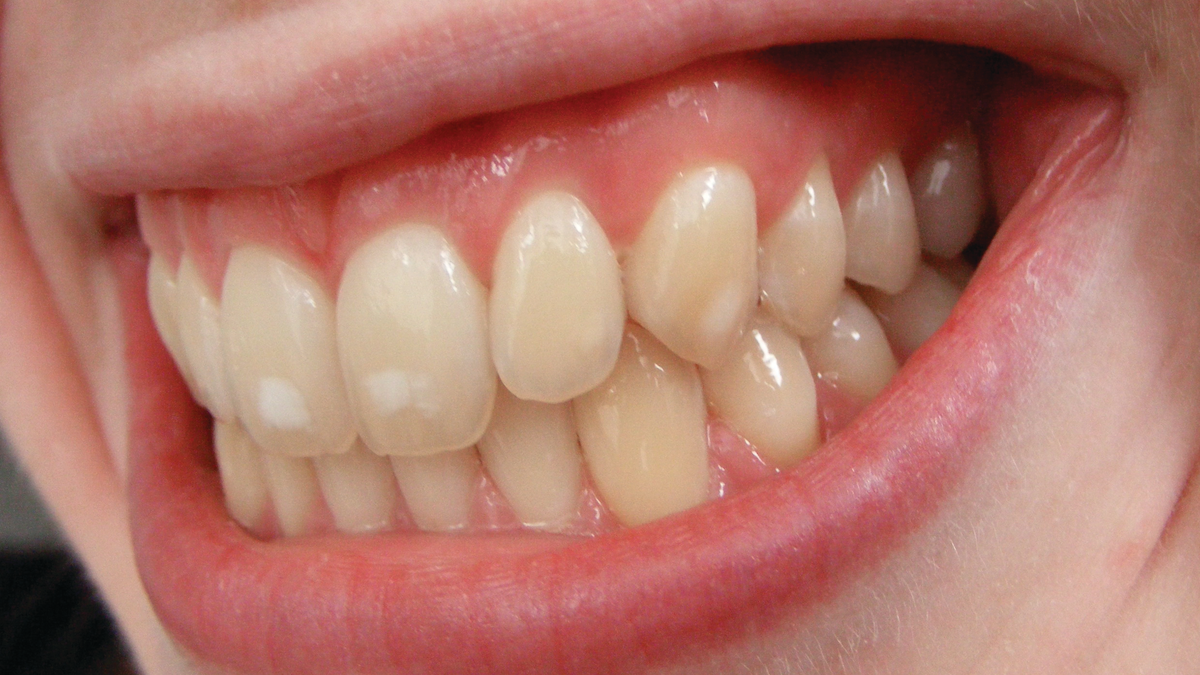 Fluoride Friend Or Foe Registered Dental Hygienist Rdh Magazine