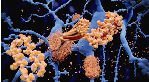 Medical illustration of the amyloid beta protein forming plaques on nerve cells
