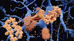 Medical illustration of the amyloid beta protein forming plaques on nerve cells Medical illustration of the amyloid beta protein forming plaques on nerve cells