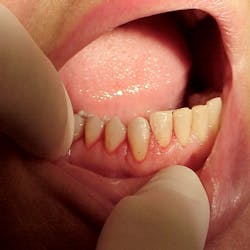 Figure 6: Treatment endpoint showing a clean, coagulated wound ready for healing Figure 6: Treatment endpoint showing a clean, coagulated wound ready for healing