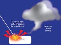 Figure 2: Example of a laser plume Figure 2: Example of a laser plume