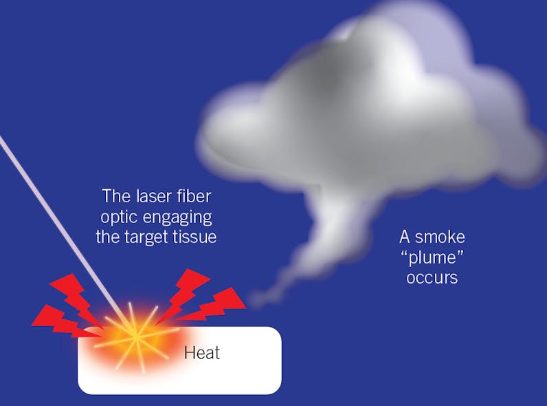 Figure 2: Example of a laser plume