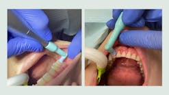 Left: PetitePearl accessing posterior teeth easily; right: PetitePearl cup adapting subgingivally
